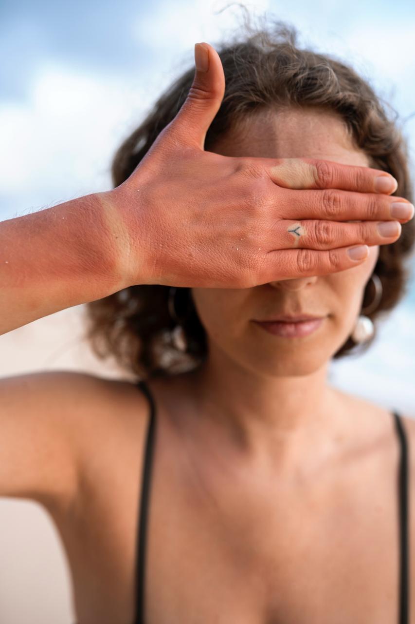 manchas solares por quemadura